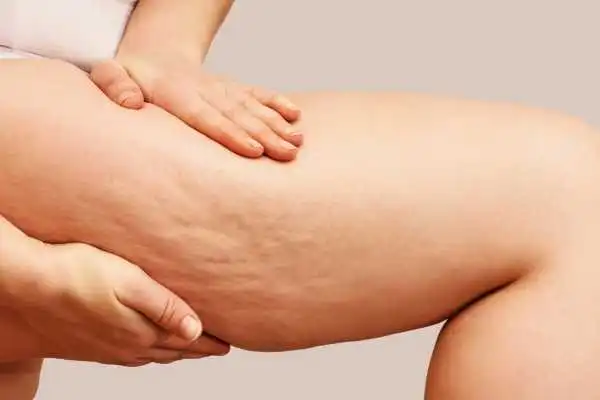Image of woman showing leg with cellulite Old Trafford