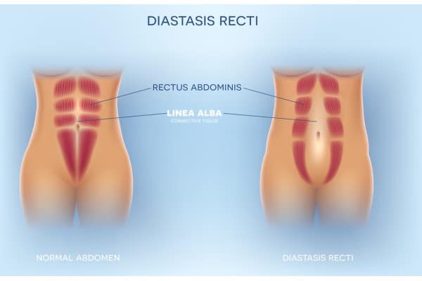 What Non-Surgical Options Are Available for Diastasis Recti Old Trafford?
