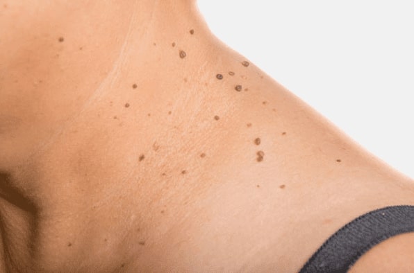 Are you looking for easy skin tag removal Old Trafford - then contact Spire today!