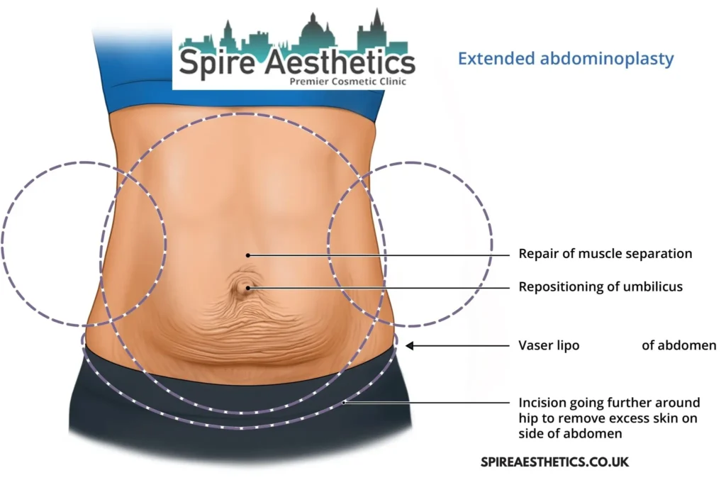 Understanding Loose Skin After Gastric Band Old Trafford Surgery and HIFU Treatment