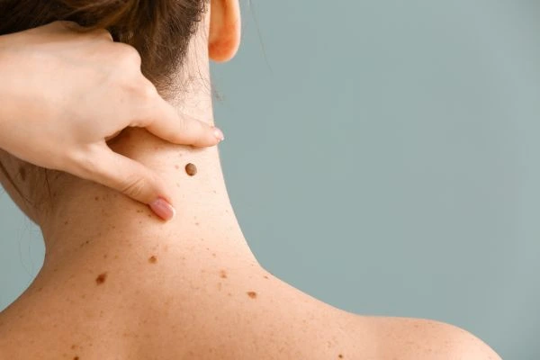 skin blemish removal Old Trafford treatment