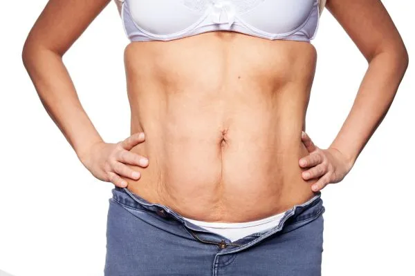 sagging skin on woman's stomach after weight loss injections Old Trafford
