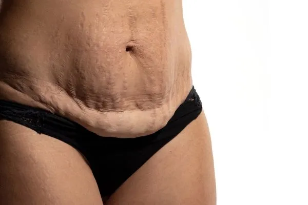 Image of womans stomach after weight loss injections Old Trafford showing saggy skin
