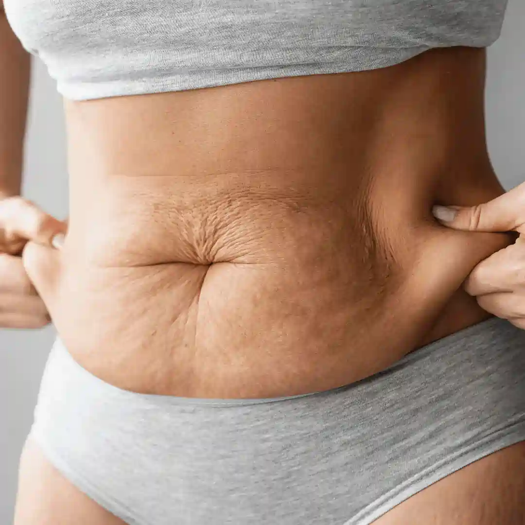 Is It Normal to Have Loose Skin After Pregnancy Old Trafford?